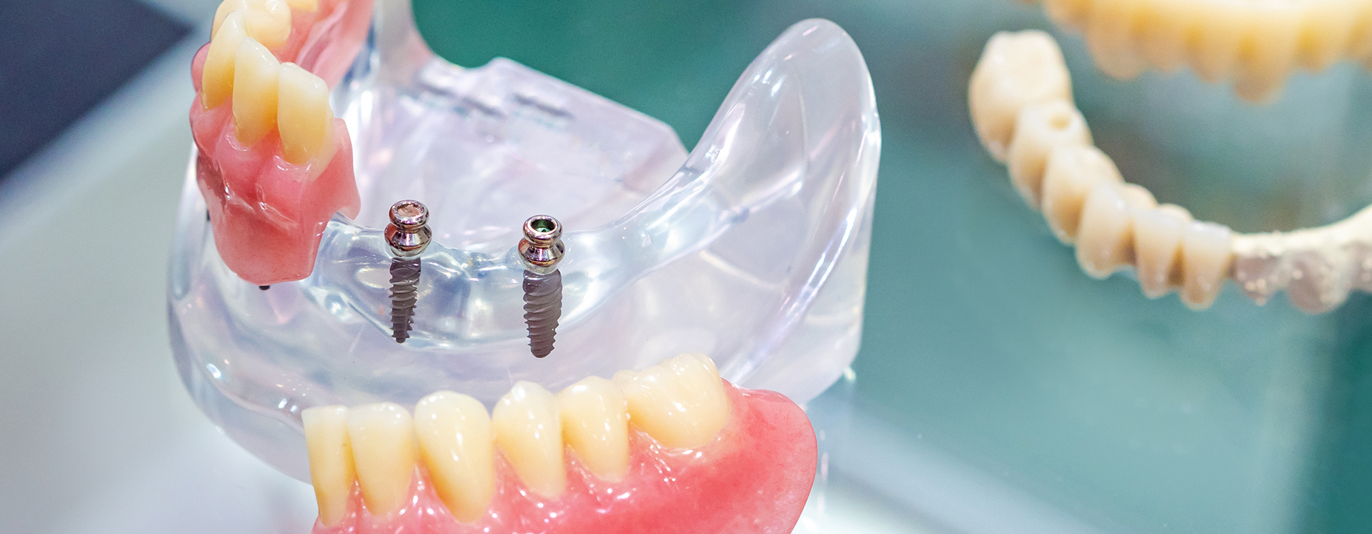 Hagerstown Family Dental | Mini Implants, Teeth Whitening and TMJ Disorders